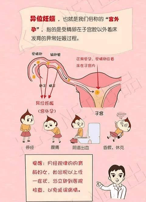 宫外孕的症状图片
