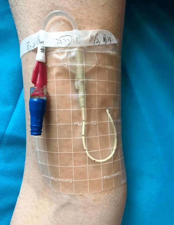 picc贴膜导致严重的皮肤过敏该怎样处理