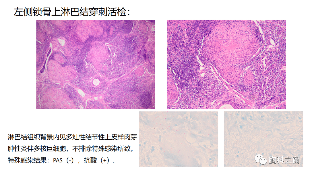 难解难分姐妹花:结节病与结核病