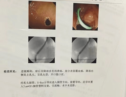 ercp检查:腹部ct:胰头部富血供占位,胰岛细胞瘤?结合实验室检查.