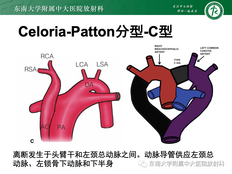 主動脈弓離斷