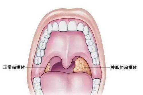 扁桃体脓栓图片图片