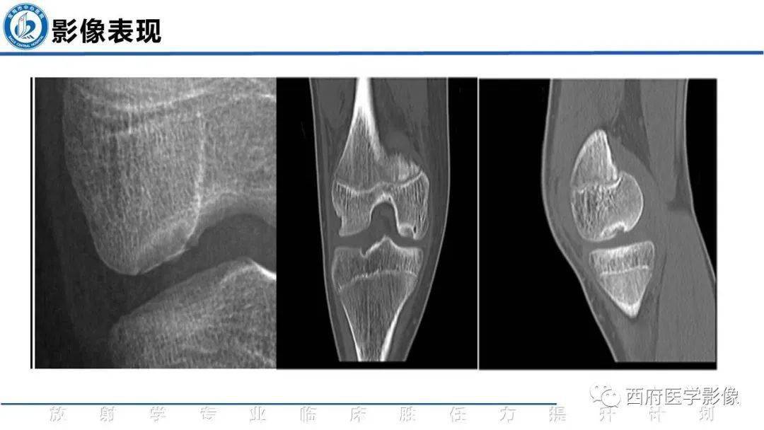 剥脱性骨软骨炎的影像表现