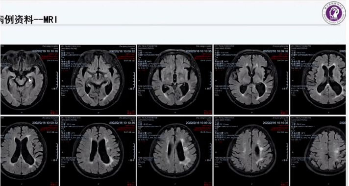 尤其在左侧侧脑室前角和侧脑室体部旁存在多发软化灶③左侧脑