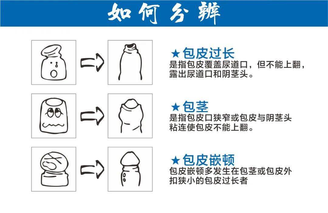 其实包皮过长有很多的潜在危害,因此要积极进行环割手术.