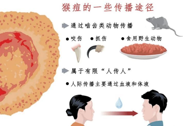 警惕猴痘病例已輸入亞洲