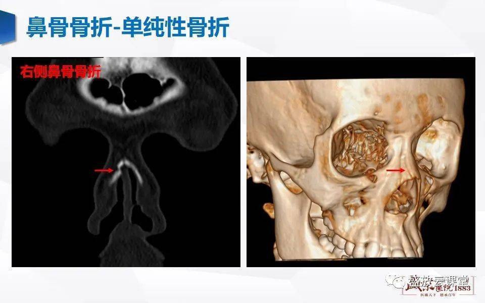 鼻骨正常CT图片图片
