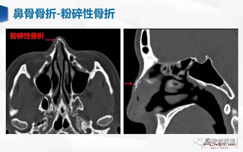 正常鼻子ct图片图片