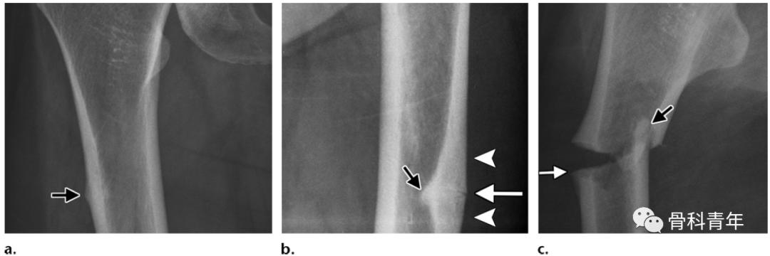 a,骨內膜及骨膜增厚;b,骨外側皮質橫行骨折;c,完全骨折,累及骨內外側