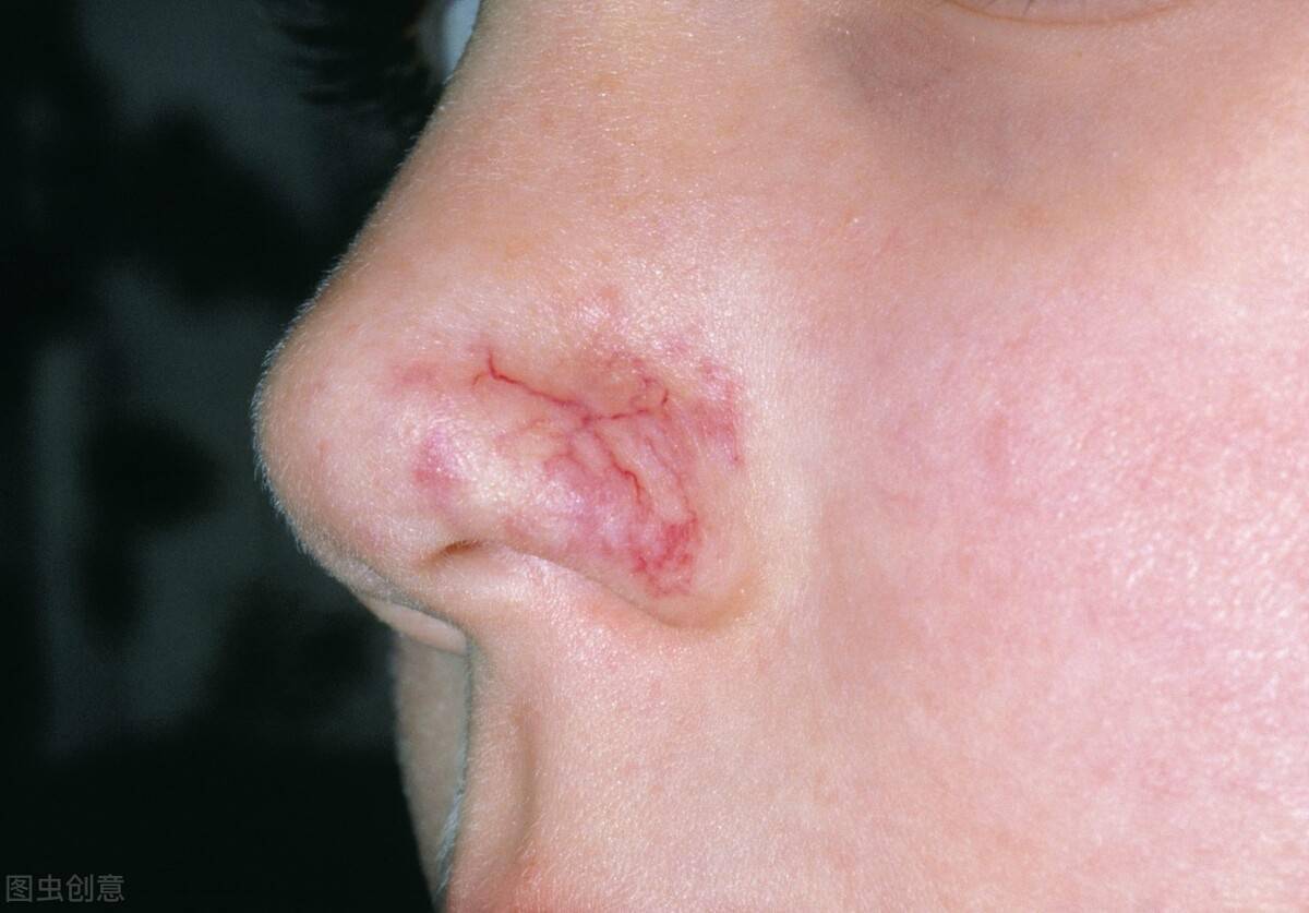 身上长红痣就是肝病的标志肝开始病变时手脚可能有4种迹象