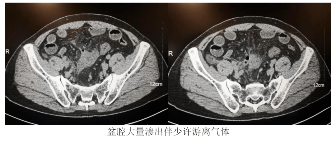 鏡下探查見患者盆腔小腸充血水腫明顯且小腸粘連成團,並與右側髂窩及