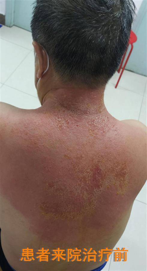 连续刮痧两天 老人“烂”后背_赵先生_湛世萍_理疗
