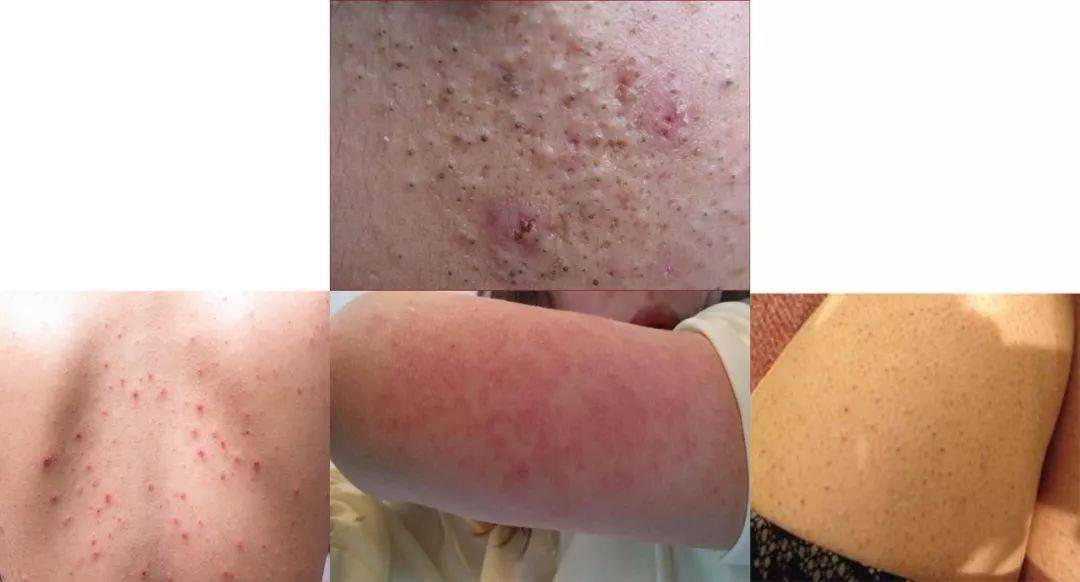 其实大多数肌肤问题都是角质堆积引起的,角质不去,皮肤就像裹上了一层