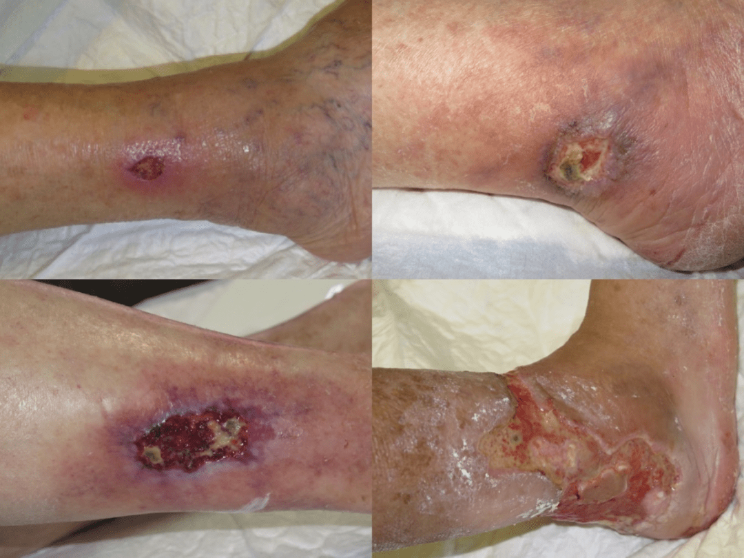 我们对于小动脉硬化性溃疡的关注太少