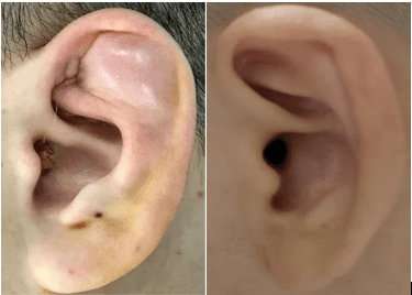 耳朵囊肿是什么引起的图片