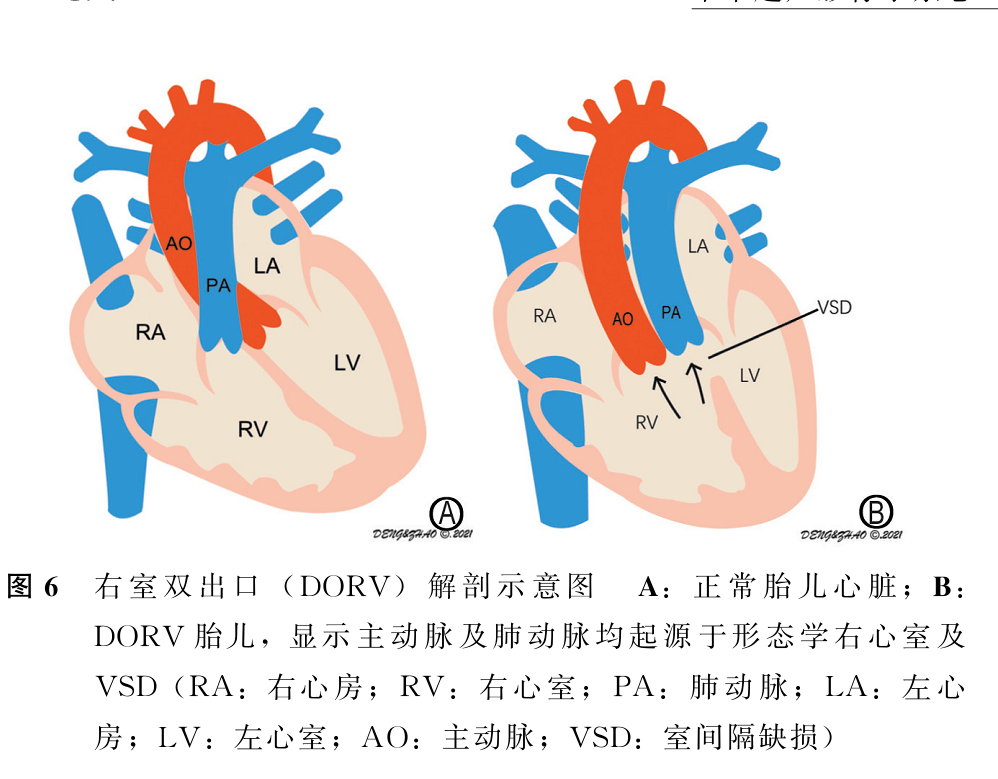 胎兒法洛四聯症和右室雙出口超聲檢查中國專家共識(2022版)(二)_動脈