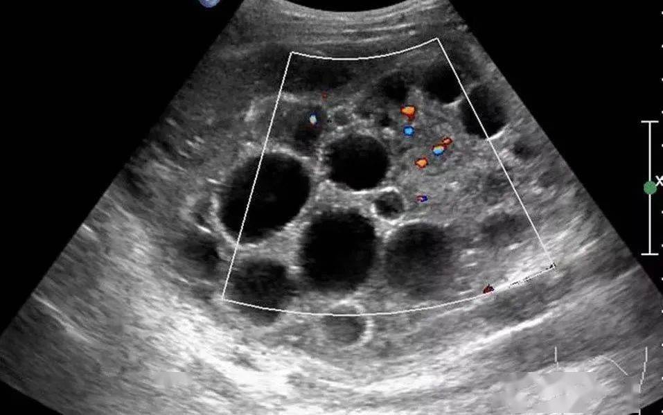 葡萄胎的超声诊断要点