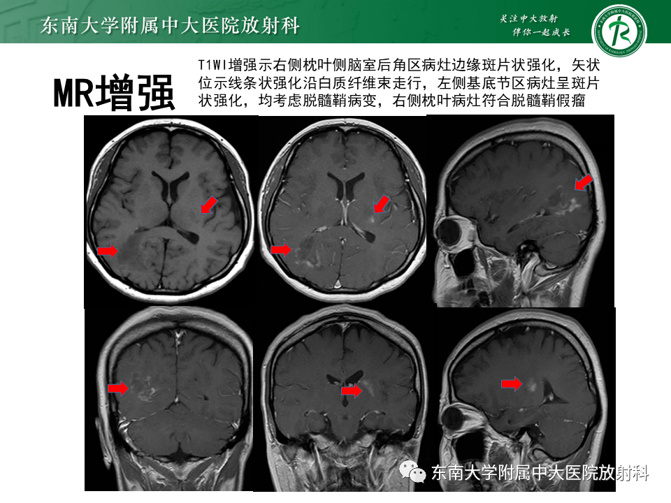 脫髓鞘假瘤影像學表現