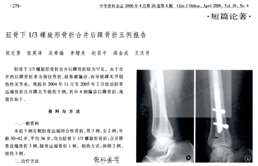 见过这个特殊类型骨折吗 胫骨 后踝 踝骨