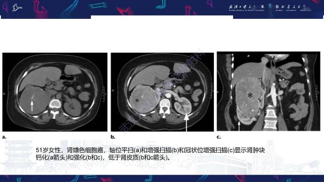 腎嫌色細胞癌影像診斷