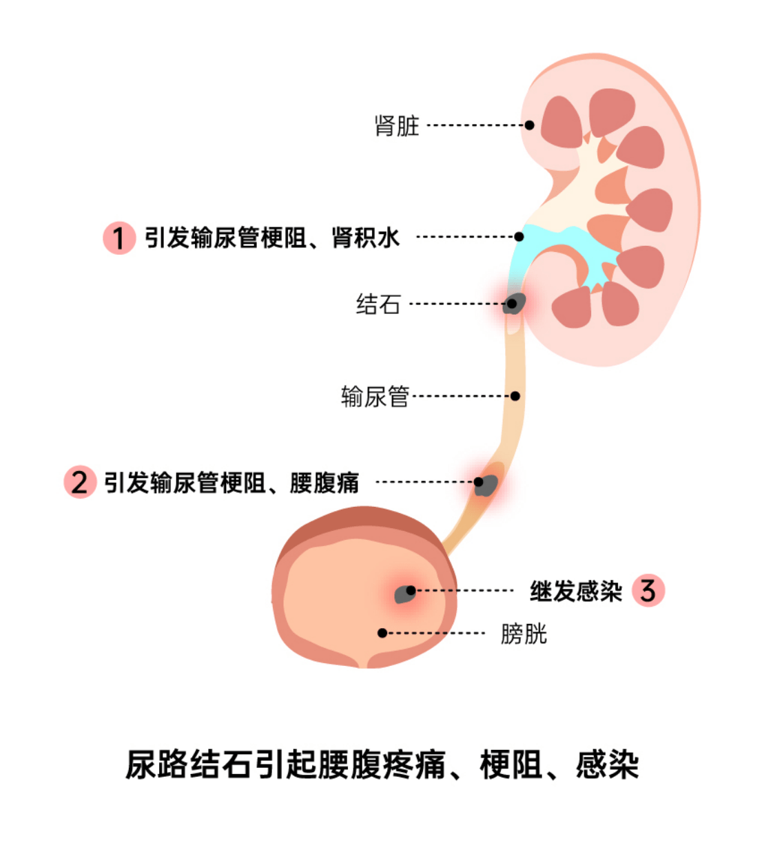 输尿管结石位置图图片