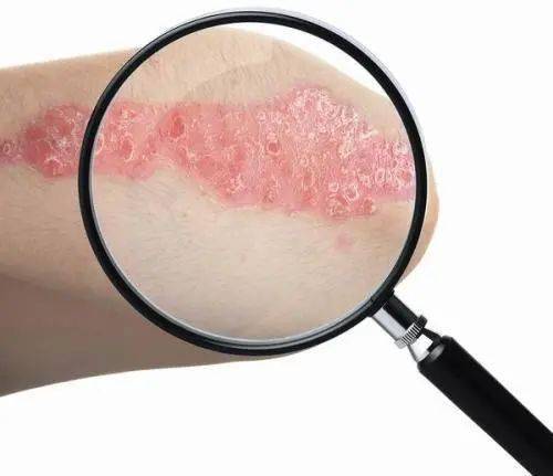 实用干货:10种常见皮肤病分辨口诀