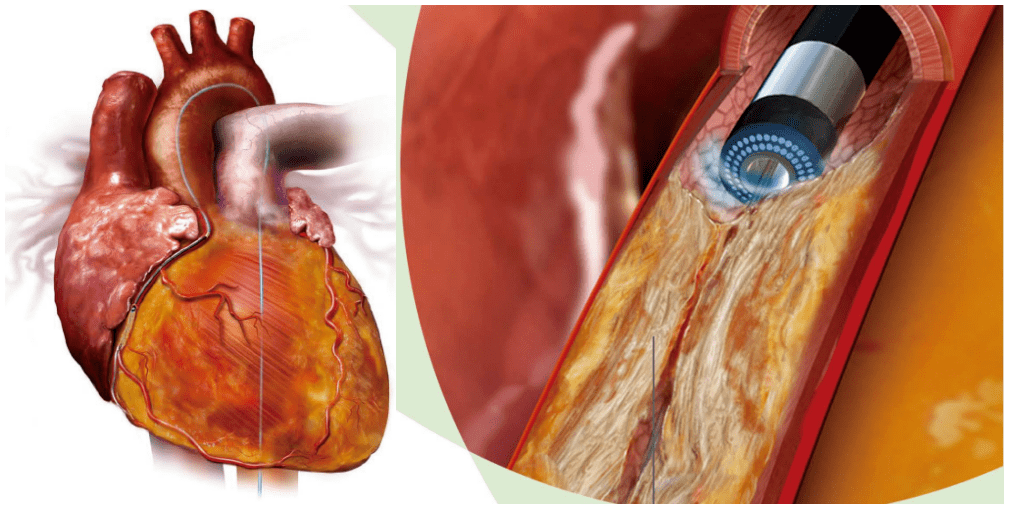 技術前沿心臟血管內也能開鑿通路浙北地區首例準分子激光冠脈內斑塊