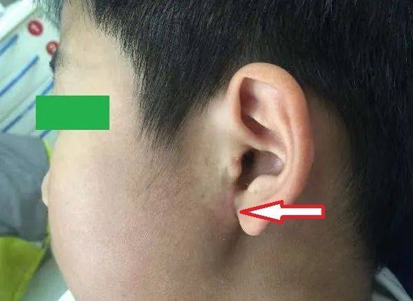 "下巴"外伤莫大意,警惕花式髁突骨折_颌面_治疗_手术