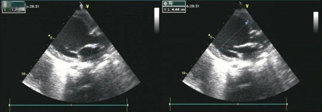 超声诊断为心内膜弹力纤维增生症,左心扩大并左心功能不全.