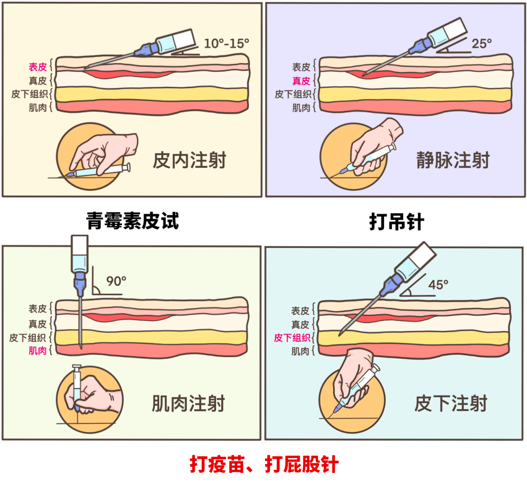臀部肌肉注射定位法图片