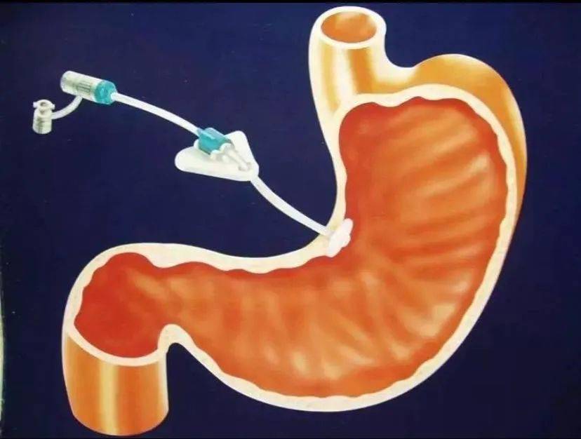 空肠造瘘营养液图片