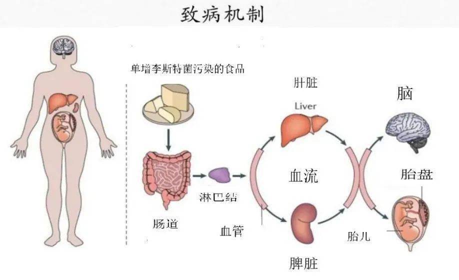 美國冰淇淋汙染事件已導致1人死亡夏季應特別當心單增李斯特菌