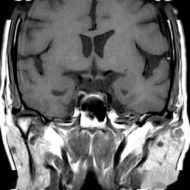 空泡蝶鞍的影像学特点,这三个征象要会看_垂体_患者_症状