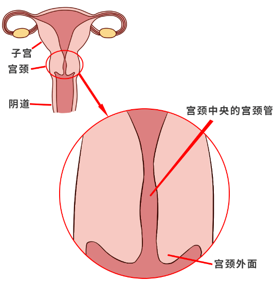 宫颈糜烂不是病那为什么三甲医院医生还让我做手术