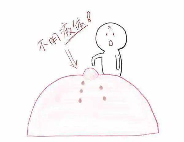 乳头溢液咋回事别慌郑州市三院甲状腺乳腺外科来帮忙