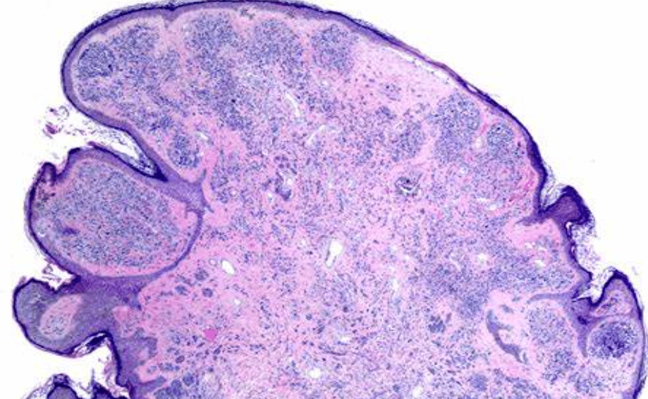 nature子刊小心痣它可能会转化为致命癌症