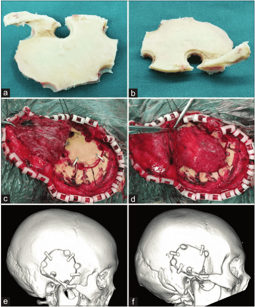 【精选编译】改良的颧颞一体化骨瓣开颅技术_研究_手术_头颅