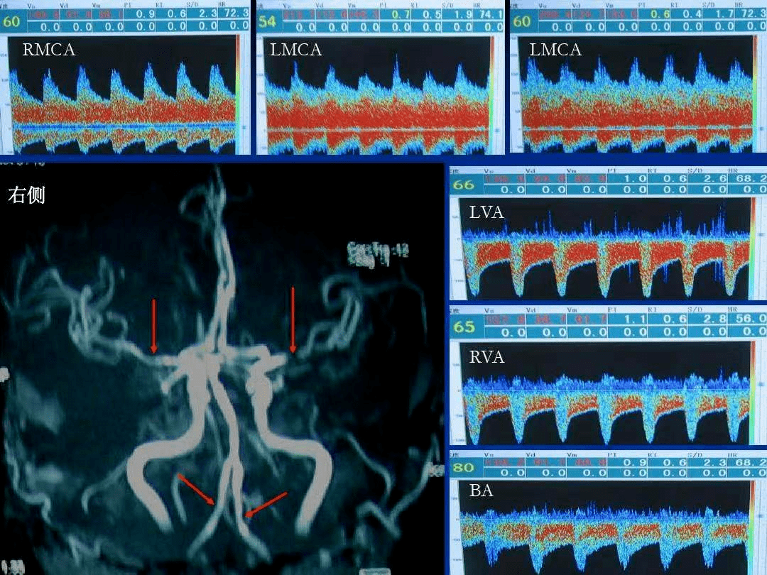 目前,烟雾病主要是通过脑血管造影(简称dsa)和头颅磁共振检查来进行