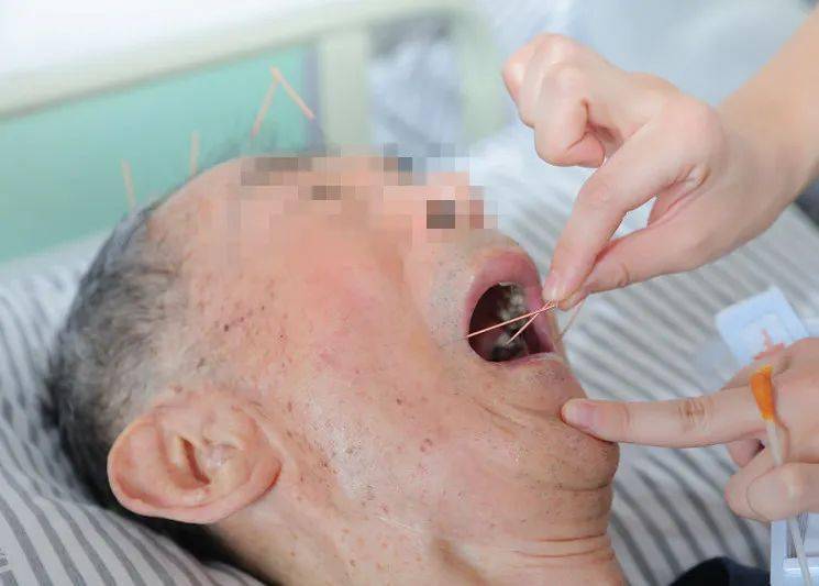 舌针2,康复治疗:包括急性期康复(比如预防并发症,正确肢位的摆放,床上