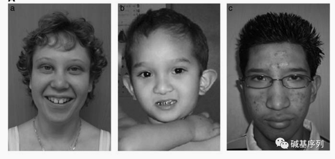3-q23.2 微缺失综合征患者普遍存在颅面畸形.
