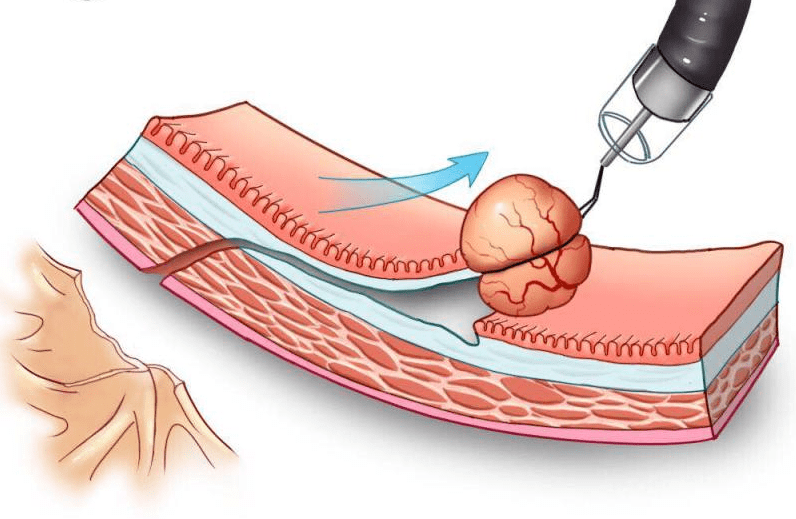 肿瘤手术竟然还能这么做,更精准,更微创