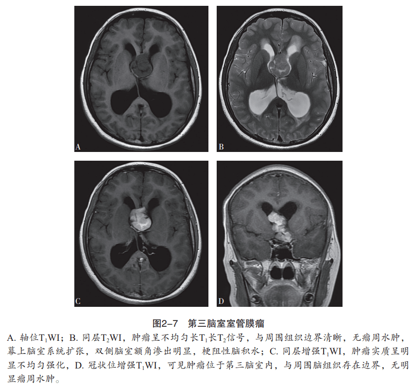 室管膜肿瘤的mri特点有哪些?