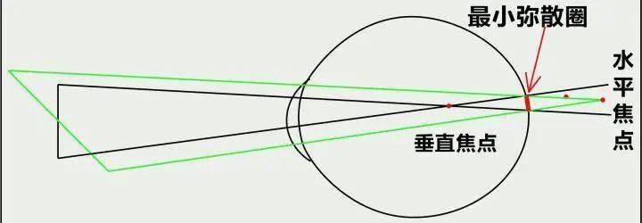 散光眼的弥散圆_屈光_视力_视网膜