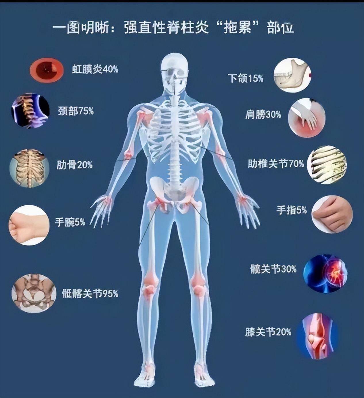 强直性脊柱炎是以脊柱为主要病变部位,累及骶髂关节,引起脊柱强直和