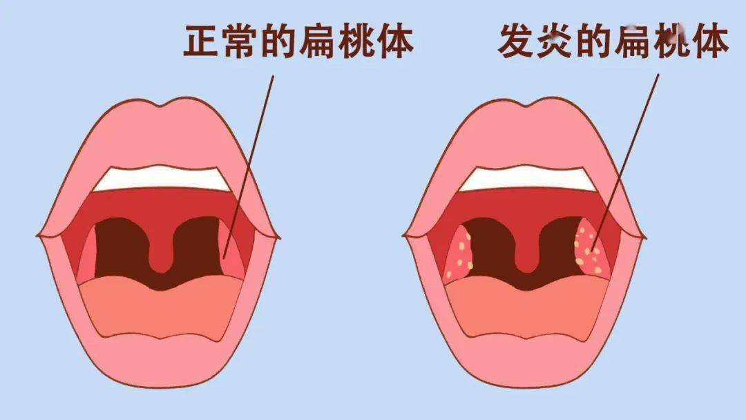 慢性舌扁桃体炎怎么治图片