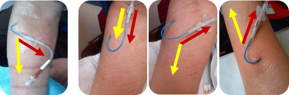 picc导管意外脱出,可能是这4大原因在作怪_患者_静脉_区域