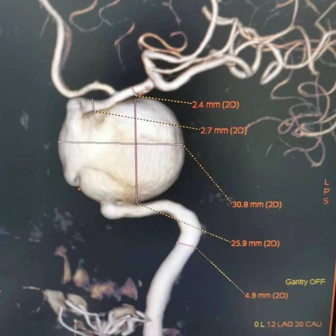 载瘤动脉瘤两锚定点切线位长度37mm;海绵窦段巨大动脉瘤,远端锚定点载