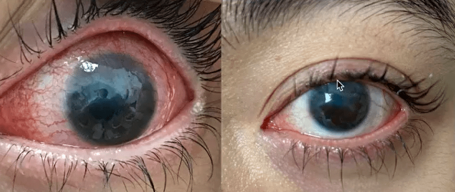 itrack名家讲坛|满晓飞医生:继发性儿童青光眼的微导管手术治疗_case