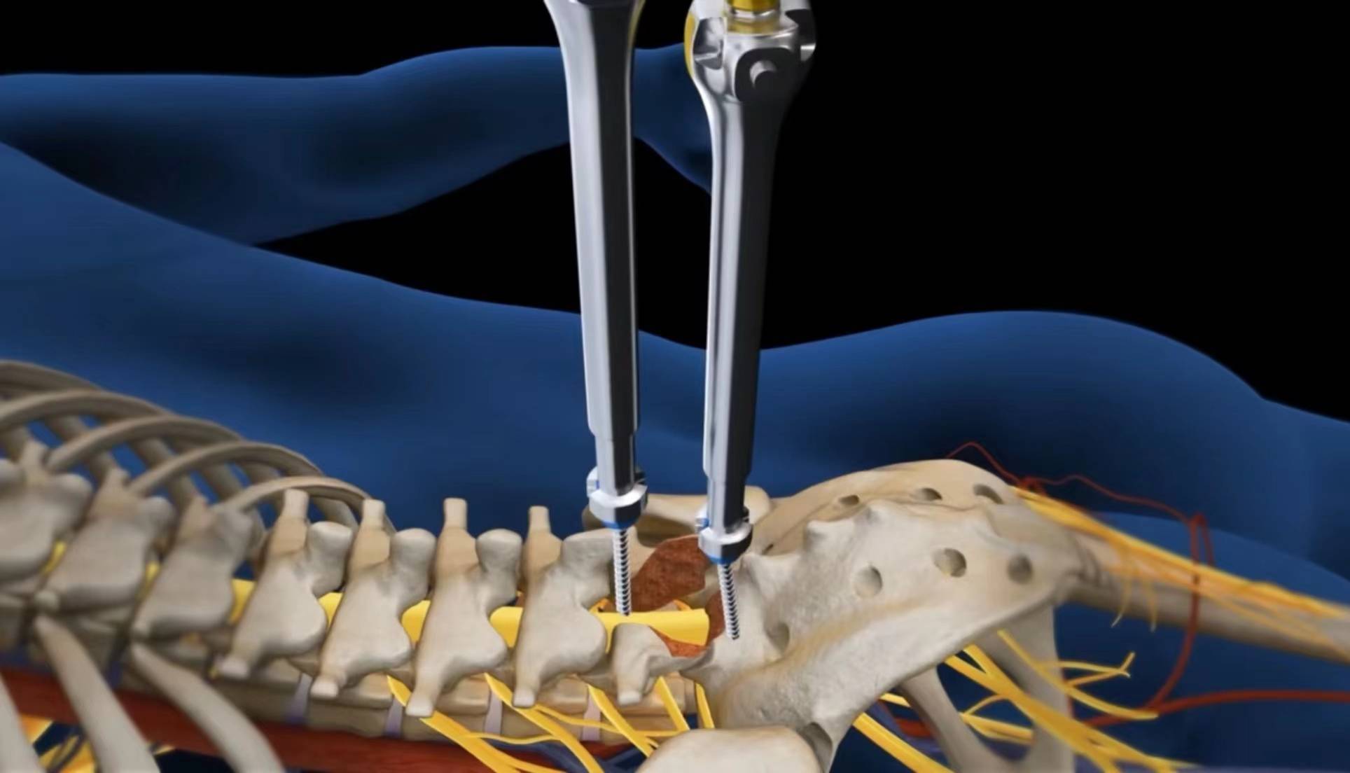 脊柱钉棒内固定术演示图片