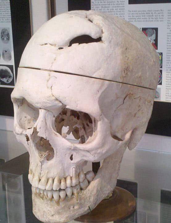 真实的不死男:铁棍刺穿头颅却谈笑风生,死后被掘尸研究_盖奇_phineas